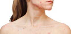 Woman with acne | Emma J Aesthetics | Inverness